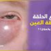 صحتك في دقائق : مرض نتوء حدقة العين الأسباب والعلاج
