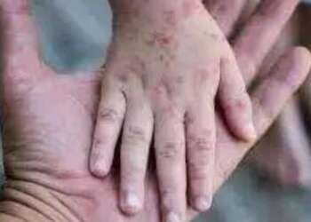انقدو أرواح أطفال من مرض “بوحمرون” بإقليم شفشاون.؟