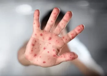 وزارة الصحة تعلن عن تسجيل حالة إصابة مؤكدة بجدري القردة